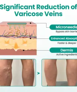 Pryxo™ LegRenew Varicose Veins Patch