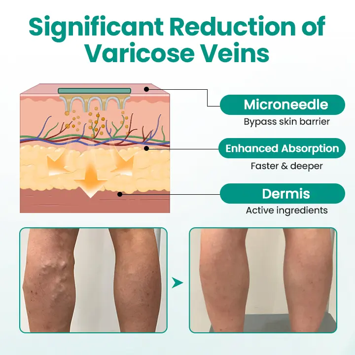 Pryxo™ LegRenew Varicose Veins Patch
