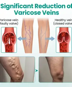 Pryxo™ LegRenew Varicose Veins Patch