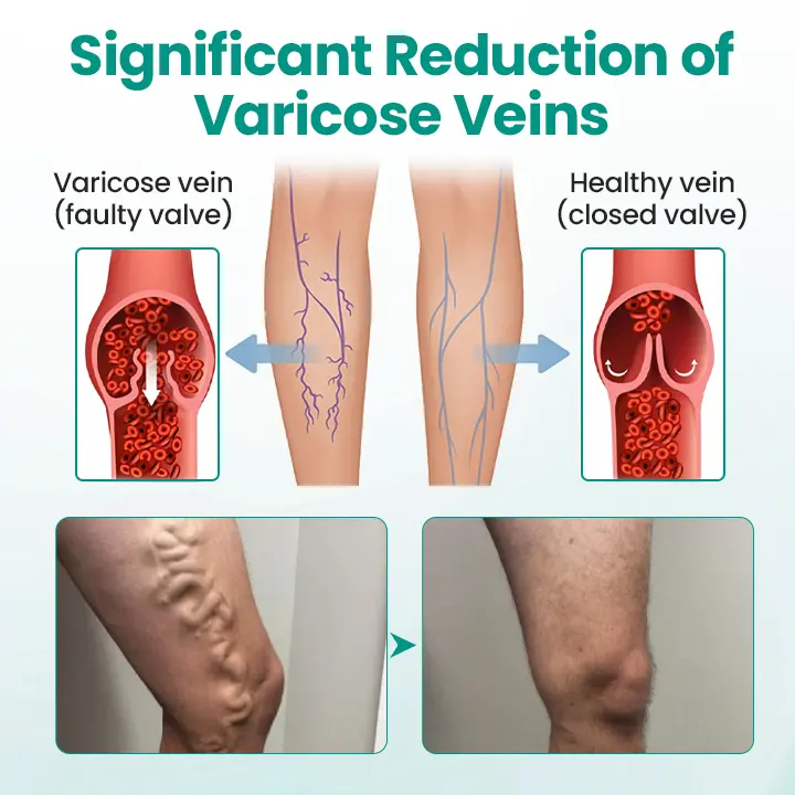 Pryxo™ LegRenew Varicose Veins Patch