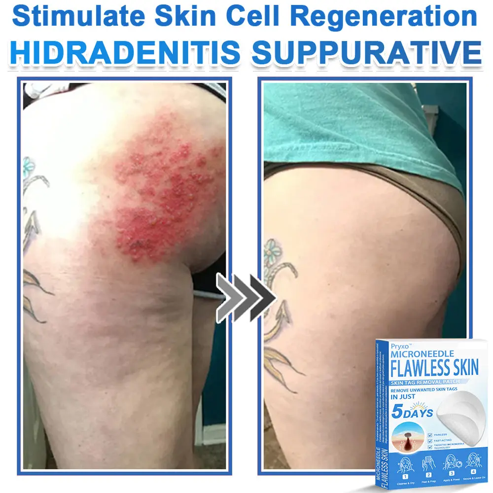 Pryxo™ 2-in-1 Microneedle & Hydrocolloid Patch