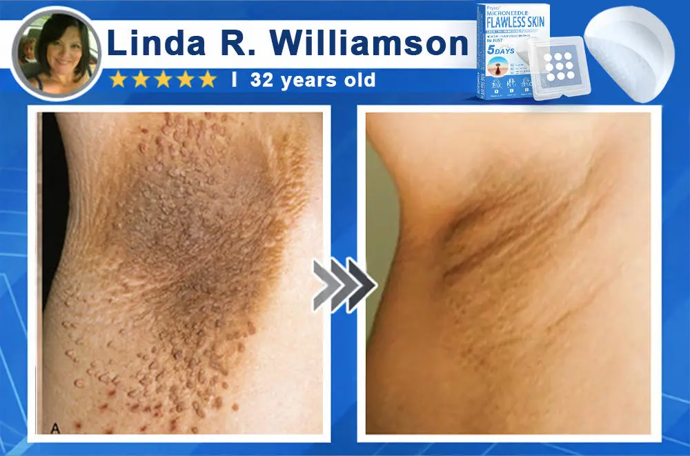 Pryxo™ 2-in-1 Microneedle & Hydrocolloid Patch