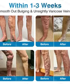 Pryxo™ VeinRepair Microneedle Patch Roll