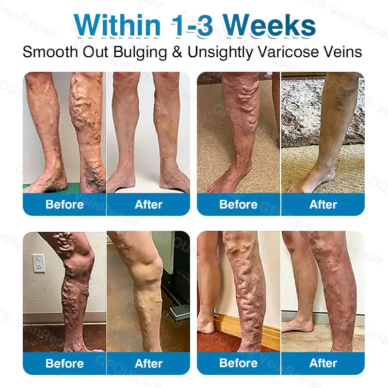 Pryxo™ VeinRepair Microneedle Patch Roll