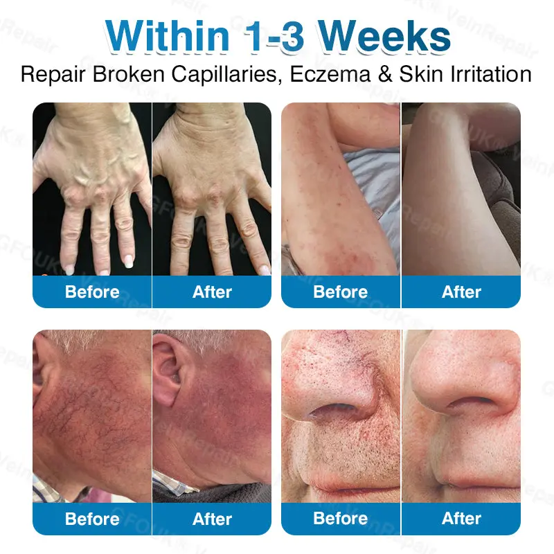 Pryxo™ VeinRepair Microneedle Patch Roll